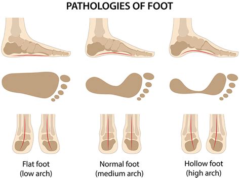 pronation erfahrungen.